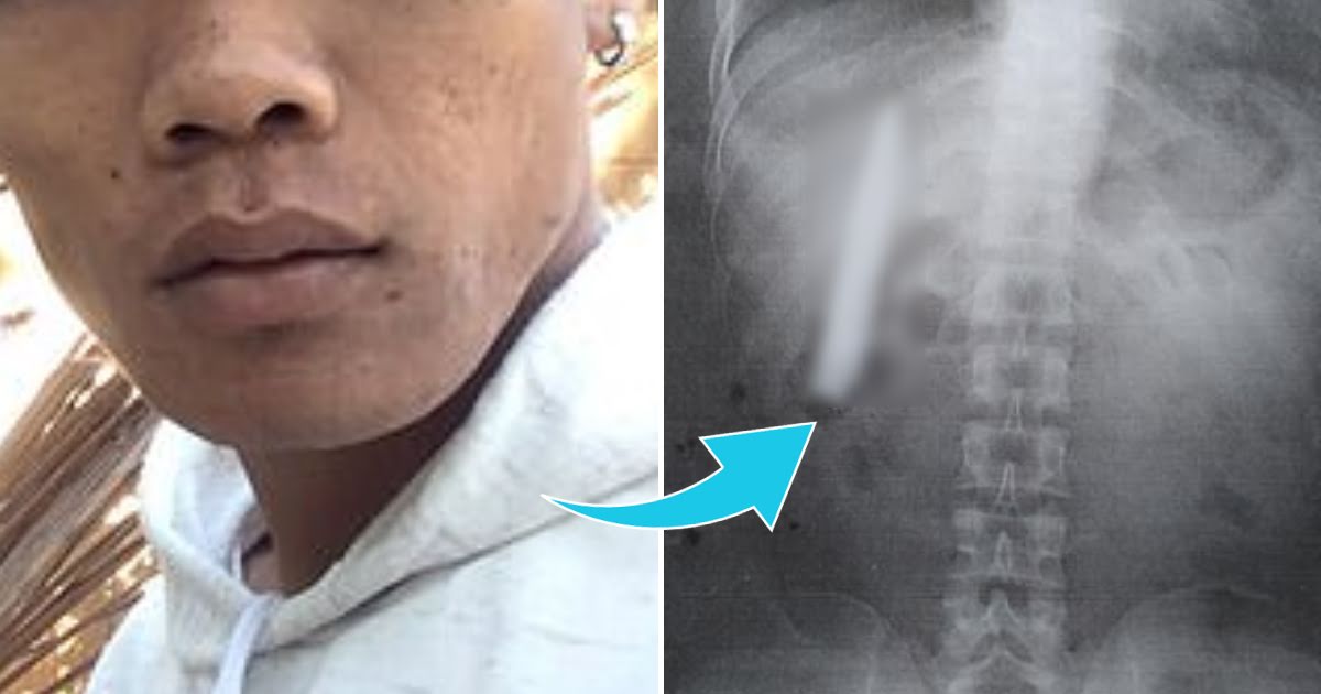 The Filipino Man Who Didn’t Know He Had A Knife Stuck Inside His Body For Over A Year