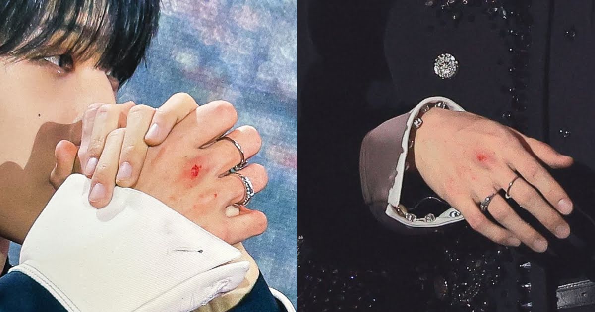 Fans Call Out Stylist After A Wardrobe Malfunction Injures NCT Dream Jisung’s Hand