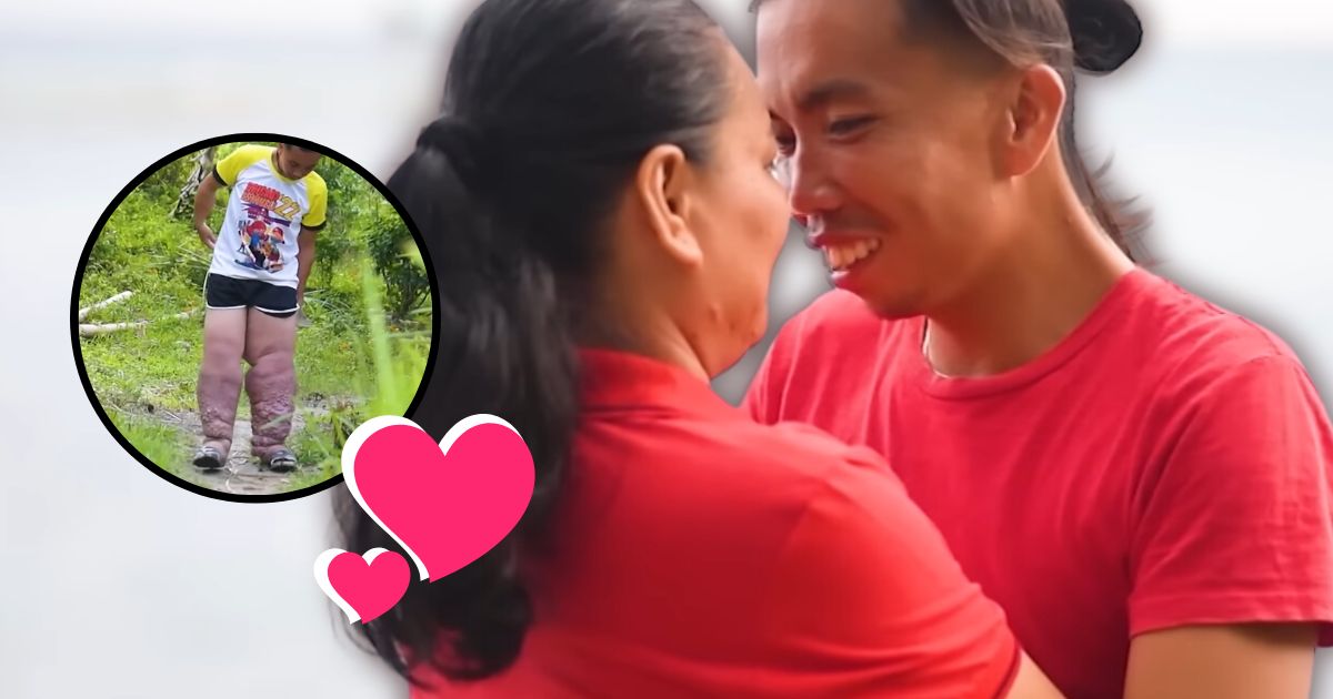 Filipino Man With “Elephant” Legs Has Tear-Jerking Love Story 6 Years In The Making