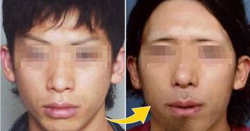 Japanese Man Performed Painful Plastic Surgery On Himself For Sinister Reason