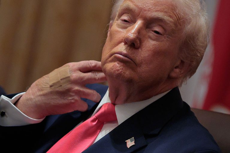 Trump’s Bandaged Hand Caught On Camera Again