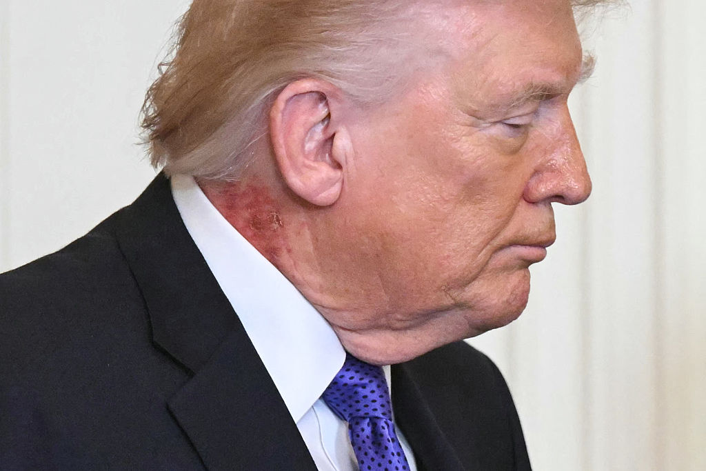 Can’t Blame Handshaking For This: Donald Trump’s Neck Rash  Internet Chatter